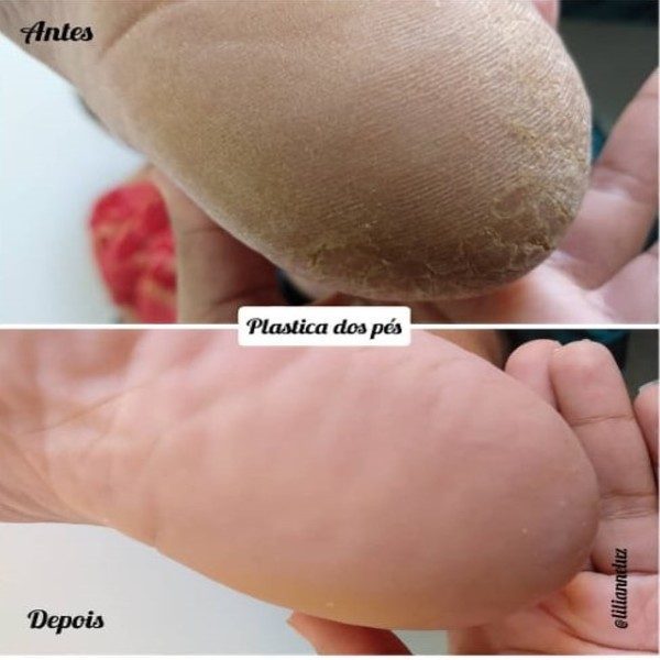 plastica nos pes antes e depois