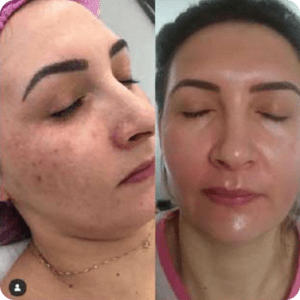 Zena Peeling de Algas resultado antes e depois